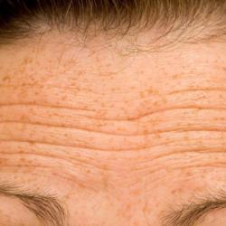 Example of pigmentation